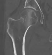 edit Medical imaging of a 79 year old woman who had a fall 3 weeks previously. Projectional radiography ("X-ray") shows a subtle subcapital radiodense line Labeled CT scan shows the same. The cortex is coherent, which is