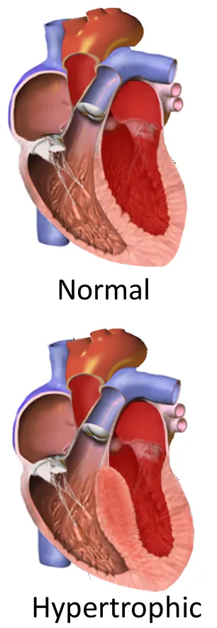 Illustration of asymmetric septal hypertorphy in HCM