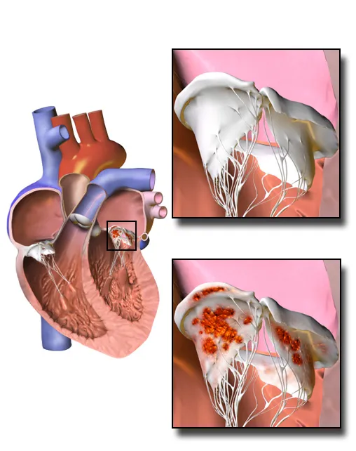 An illustration of endocarditis.
