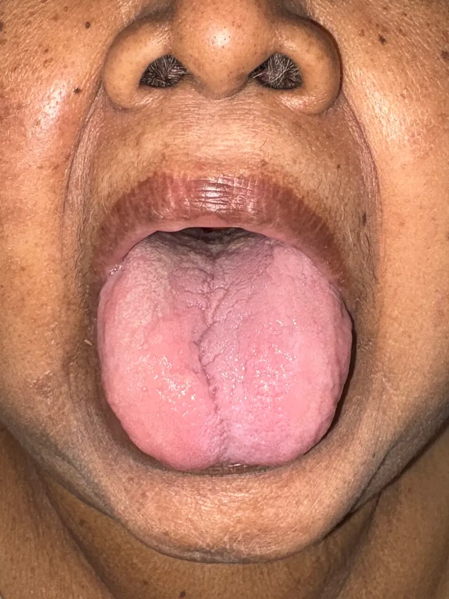 This case of a Thai female adult was presented to a public hospital in northern Thailand with complaints of tongue enlargement. The diagnosis of glossitis was made. Further investigation revealed anaemia where iron-defic