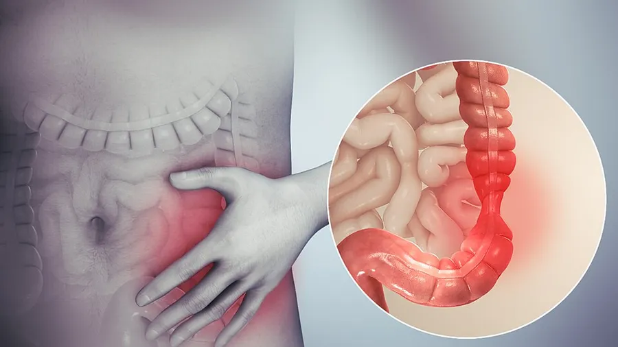 3D medical animation still showing Irritable bowel syndrome and tenesmus in the pip.