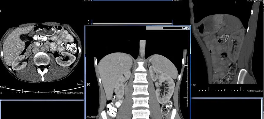 a CT scan of my kidney