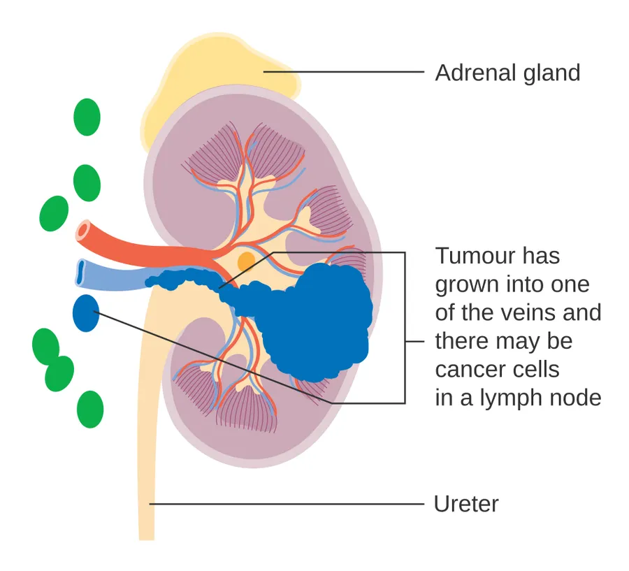 Diagram showing stage 3 kidney cancer.