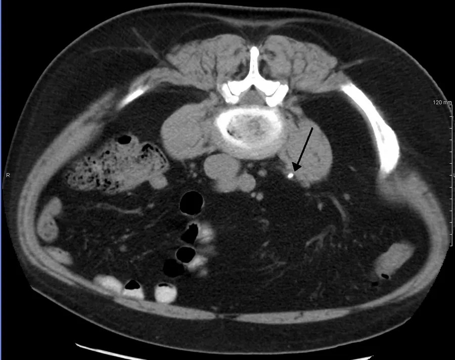 3 mm stone in the ureter