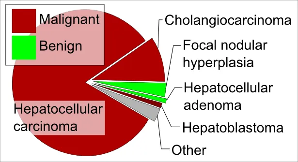 Liver tumor types by relative incidence in adults in the United States. Reference: Table 37.2 in: Sternberg, Stephen (2012) Sternberg's diagnostic surgical pathology, LWW ISBN: 978-1-4511-5289-0. OCLC: 953861627.