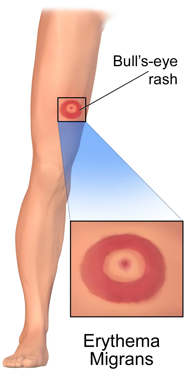 Lyme Disease.