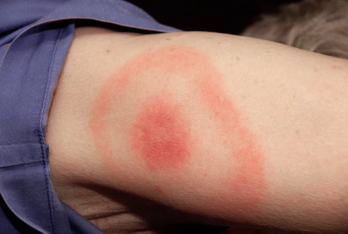 This 2007 photograph depicts the pathognomonic erythematous rash in the pattern of a “bull’s-eye”, which manifested at the site of a tick bite on this Maryland woman’s posterior right upper arm, who’d subsequently contra