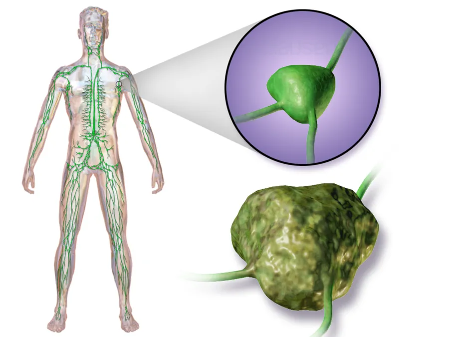 Lymphoma.