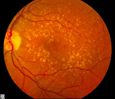 Description: A fundus photo showing intermediate age-related macular degeneration. Credit: National Eye Institute, National Institutes of Health Ref#: EDA2