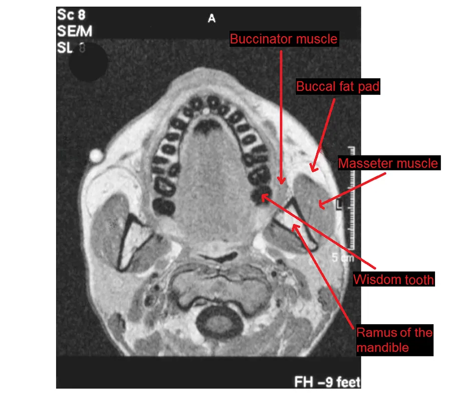 A horizontal MRI of a head, at the level of the mandibular teeth, showing the masseter muscle, buccinator muscle, buccal fat pad, ramus of the mandible and wisdom tooth.