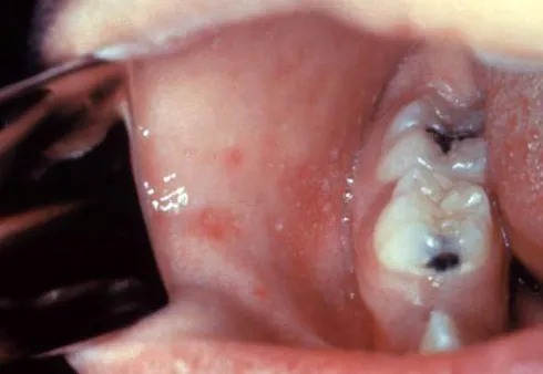 This patient presented on the third pre-eruptive day with “Koplik spots” indicative of the beginning onset of measles. In the prodromal or beginning stages, one of the signs of the onset of measles is the eruption of “Ko