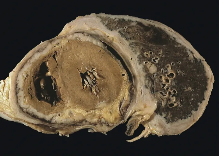 SEROSAL MEMBRANES: DIFFUSE PLEURAL MESOTHELIOMA Extensive involvement of the pericardium. (Courtesy of Dr. Samuel Hammar, Seattle, WA.)