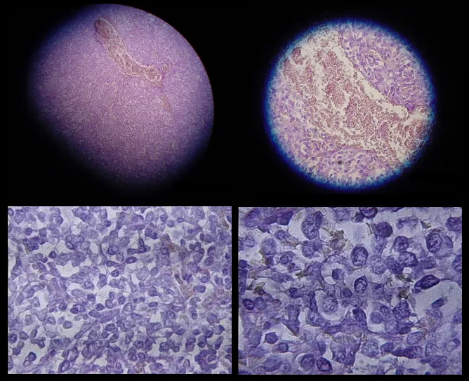 Mesothelioma is a form of cancer that is almost always caused by exposure to asbestos. In this disease, malignant cells develop in the mesothelium, a protective lining that covers most of the body's internal organs. Its