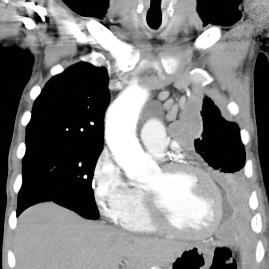Coronal reformat of a CT of the chest in a patient with left sided mesothelioma. Note the extensive pleural mass with contraction of the left hemithorax. This image is from the full mesothelioma case at Radiopaedia.org