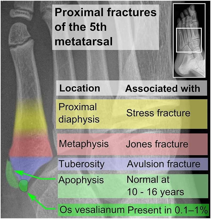 editProximal fractures of 5th metatarsal: Proximal fractures of the fifth metatarsal are common,[1] and are distinguished by their locations: A proximal diaphysis fracture is typically a stress fracture, commonly among a