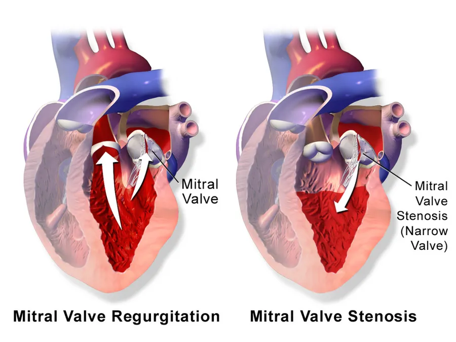 Mitral Valve Regurgitation vs. Mitral Valve Stenosis.