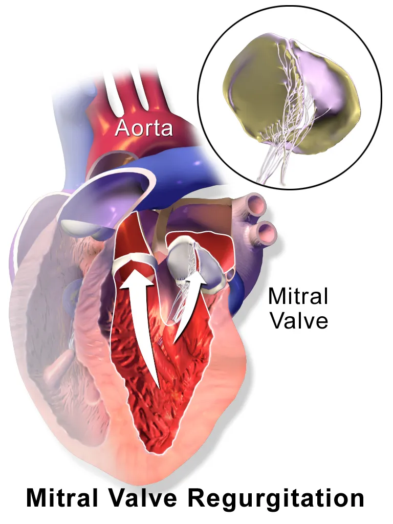 A medical illustration depicting mitral valve regurgitation.