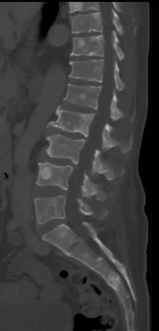 CT scan of the lower vertebral column in a 57 year old man with multiple myeloma, showing multiple osteoblastic lesions. These are more radiodense (brighter in this image) than the surrounding cancellous bone, in contras