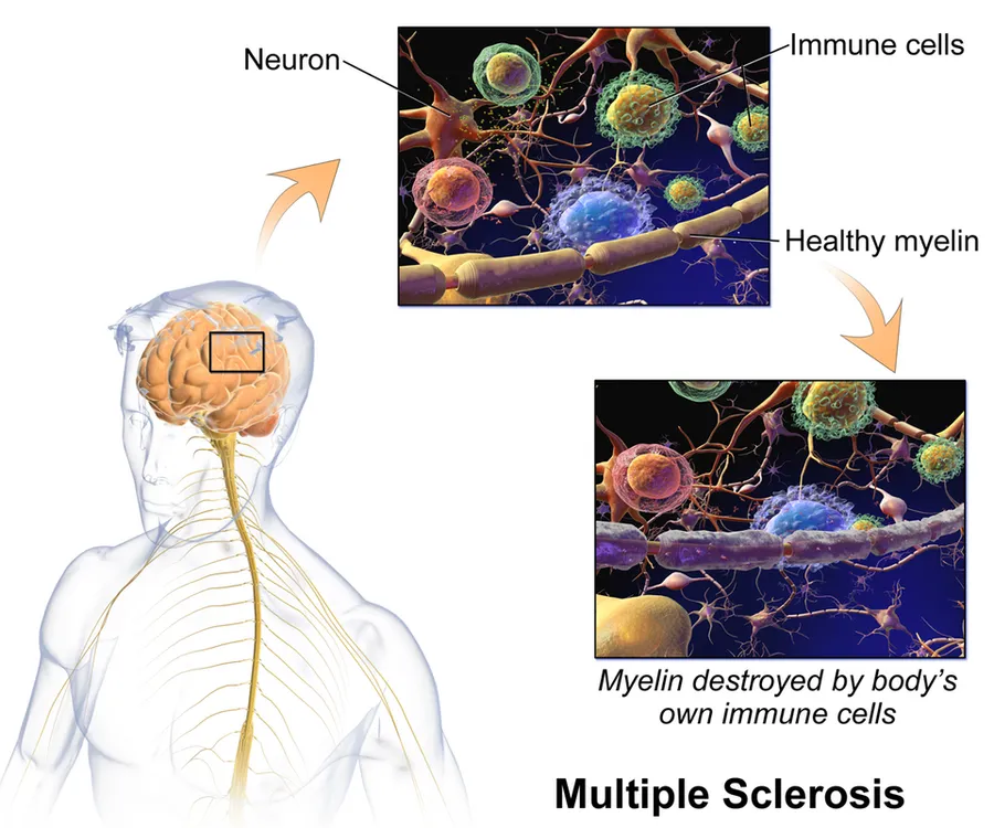Multiple Sclerosis.
