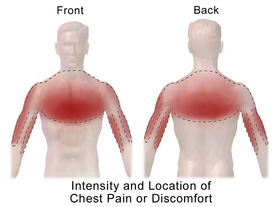 An illustration depicting a heart attack and chest pain.