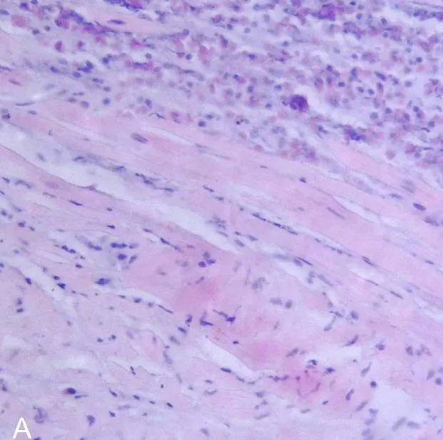 Endomyocardial biopsy specimen. Extensive eosinophilic infiltrate involving the endocardium and myocardium (hematoxylin and eosin).