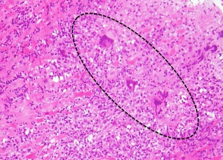 Histopathology of giant-cell myocarditis, with multinucleated giant cells. H&E stain.