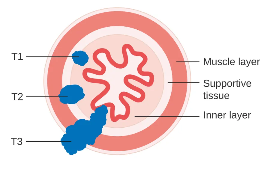 Diagram showing T1,T2 and T3 stages of oesophageal cancer.