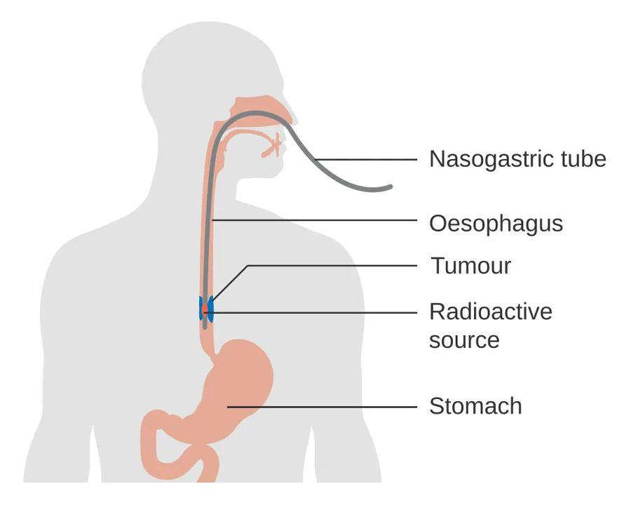 Diagram showing internal radiotherapy for cancer of the oesophagus.