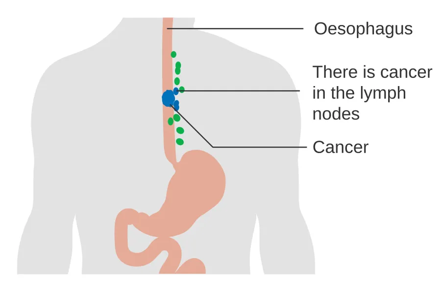 Diagram showing oesophageal cancer in the lymph nodes (N staging).