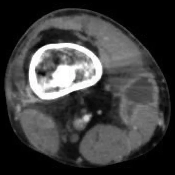 Mycobacterium doricum Osteomyelitis and Soft Tissue Infection, Figure A1. Computed tomography scan of the right lower extremity of a 21-year-old patient, showing abscess formation adjacent to nonunion of a right femur fr