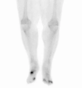 Osteomyelitis in both feet as seen on bone scan