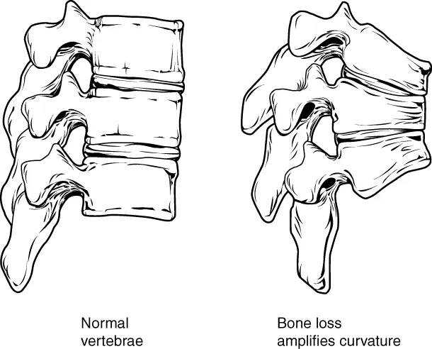 Osteoporosis is an age-related disorder that causes the gradual loss of bone density and strength. When the thoracic vertebrae are affected, there can be a gradual collapse of the vertebrae. This results in kyphosis, an