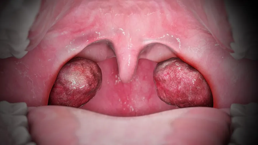 Medical Animation Still Showing Palatine Tonsil.