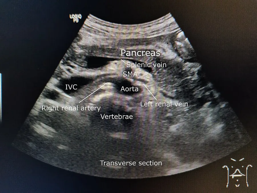 Axial section of the epigastric region showing splenic vein, pancreas, inferior vena cava (IVC), abdominal aorta, and superior mesenteric artery (SMA).