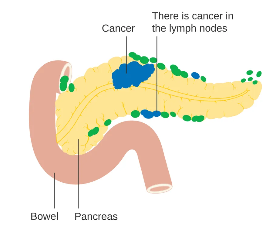 Diagram showing pancreatic cancer in the lymph nodes (N staging).