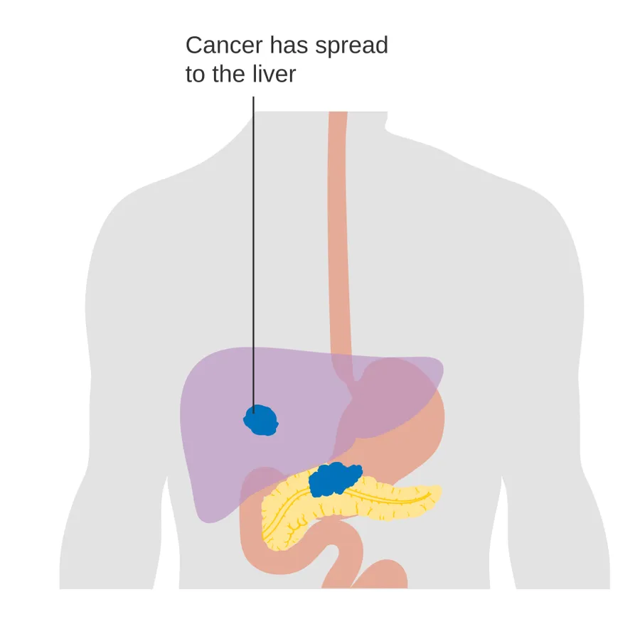 Diagram showing pancreatic cancer that has spread (M staging).