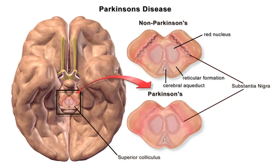 Parkinson's Disease.