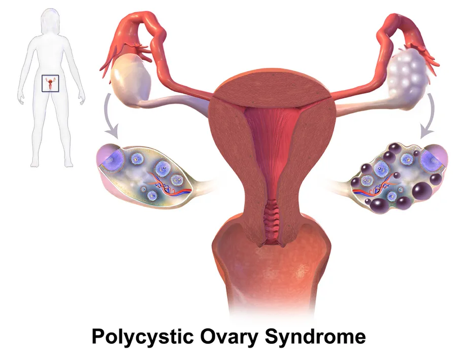A medical illustration depicting PCOS.