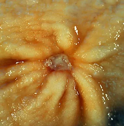 gastric ulcer This 1-cm benign gastric antral ulcer was discovered serendipitously in a gastrectomy specimen removed for adenocarcinoma of the fundus (not shown in the photo). The gross appearance is classic for a benign