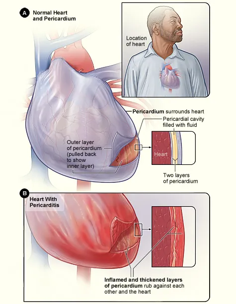 Figure A shows the location of the heart and a normal heart and pericardium (the sac surrounding the heart). The inset image is an enlarged cross-section of the pericardium that shows its two layers of tissue and the flu
