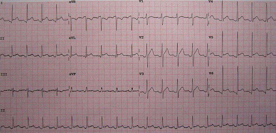 An ECG showing pericarditis