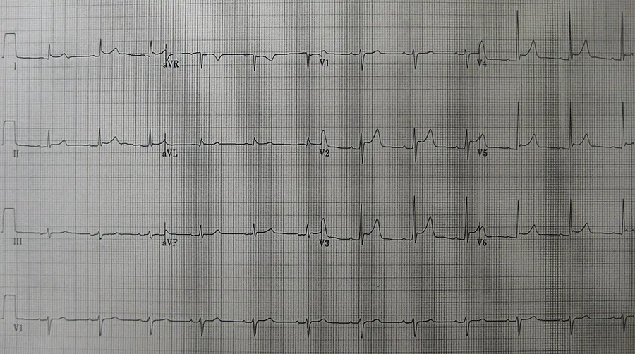 An ECG showing pericarditis. Note the ST elevation in multiple leads with reciprocal ST depression in aVR.