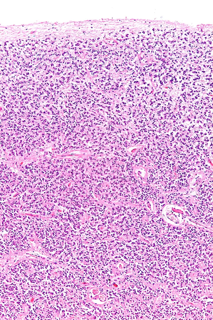 Intermediate magnification micrograph of a normal pineal gland. H&E stain. The pineal gland is very cellular and can be mistaken for a neoplasm.[1] Related images Low mag. High mag. Very high mag. References ↑ Kleins