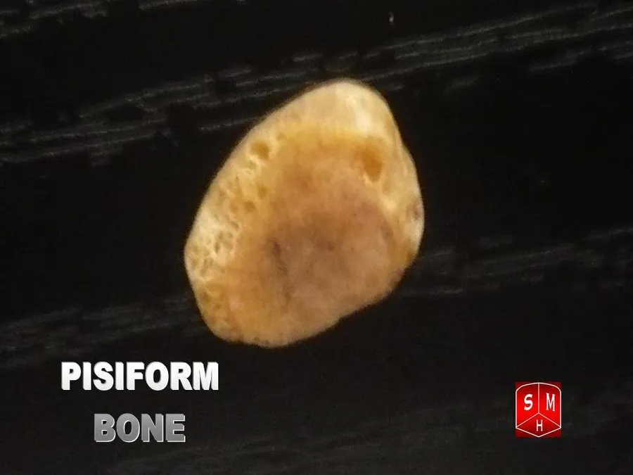 Pisiform bone