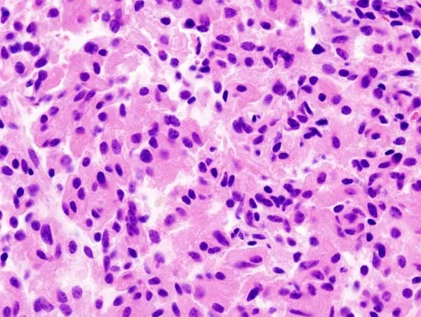 Histopathological image of pituitary adenoma. The same as shown in a file "Pituitary_adenoma_(1)_GH_production.jpg". Hematoxylin & esoin stain.