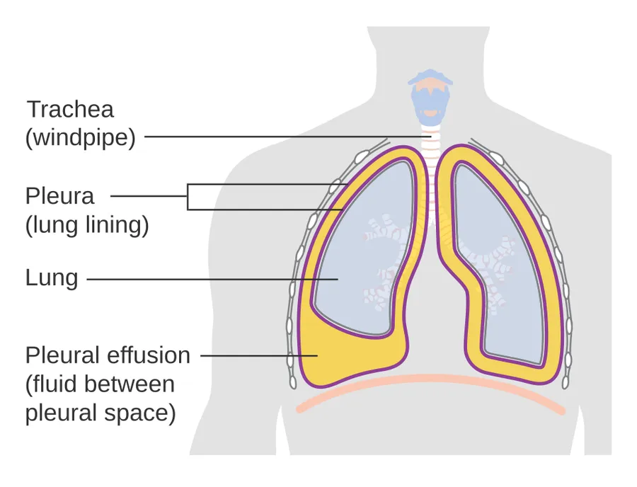 Diagram showing a build up of fluid in the lining of the lungs (pleural effusion).