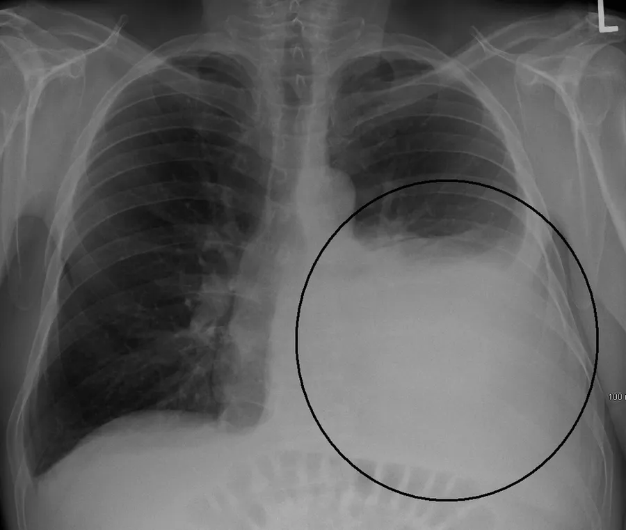 A large left sided pleural effusion as seen on an upright chest X-ray
