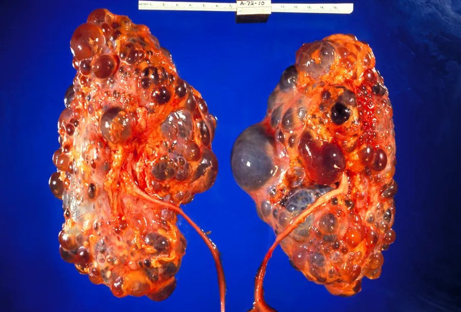 This photograph reveals gross pathologic changes in a case of polycystic kidney disease. The two ureters are also visible.