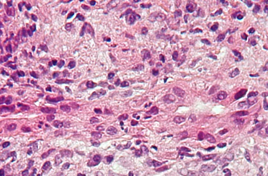 Intermediate magnification micrograph of primary biliary cirrhosis. Liver biopsy. H&E stain. Features: Bile duct intraepithelial lymphocytes - key feature. Bile duct epithelial cells with eosinophilic cytoplasm. Gran