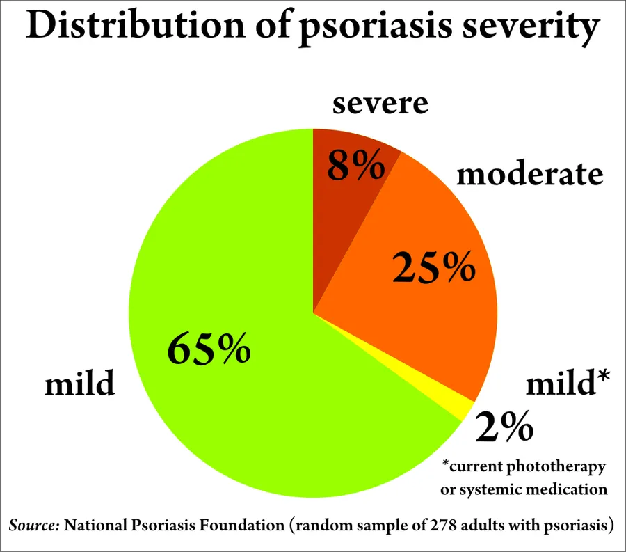 Pie chart depicting the distribution of psoriasis severity, with 65% as mild, 25% as moderate, 8% as severe, and 2% as mild due to phototherapy. Data is from the National Psoriasis Foundation, using a random sample of 27